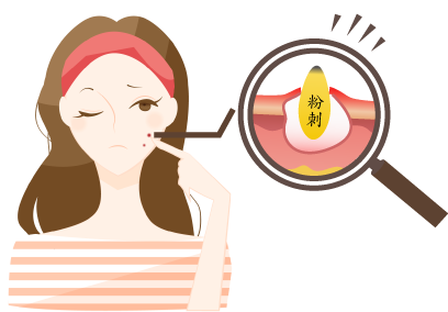 诱发粉刺的原因