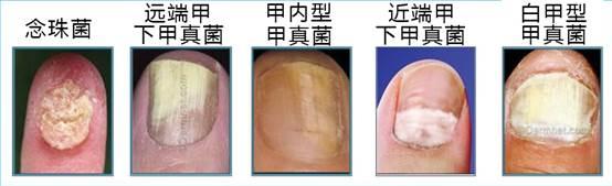 灰指甲可以吗