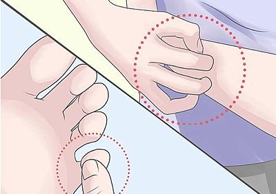 掌握手足癣分型