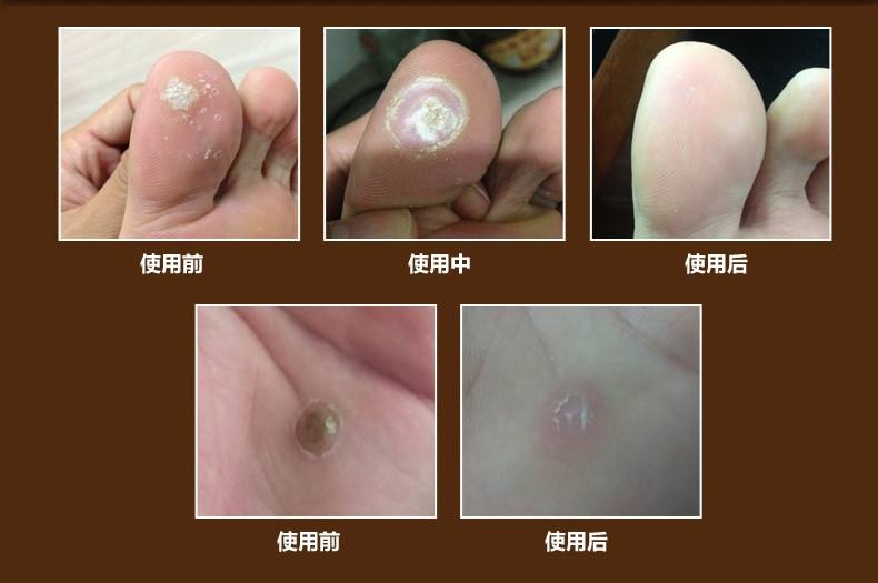病毒疣的治疗