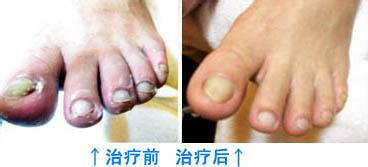 手足藓怎么医治