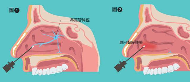 过敏性鼻炎的自我疗法
