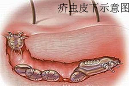 疥疮早期症状图片