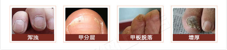 甲沟炎是什么