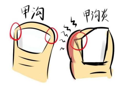得了甲沟炎应该怎么护理