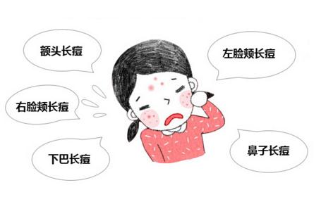 痤疮的主要诱因有哪些