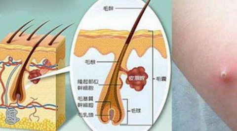 毛囊炎的常识有哪些