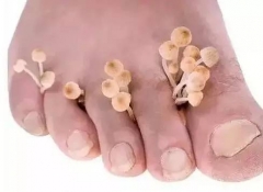 脚气病症有哪些