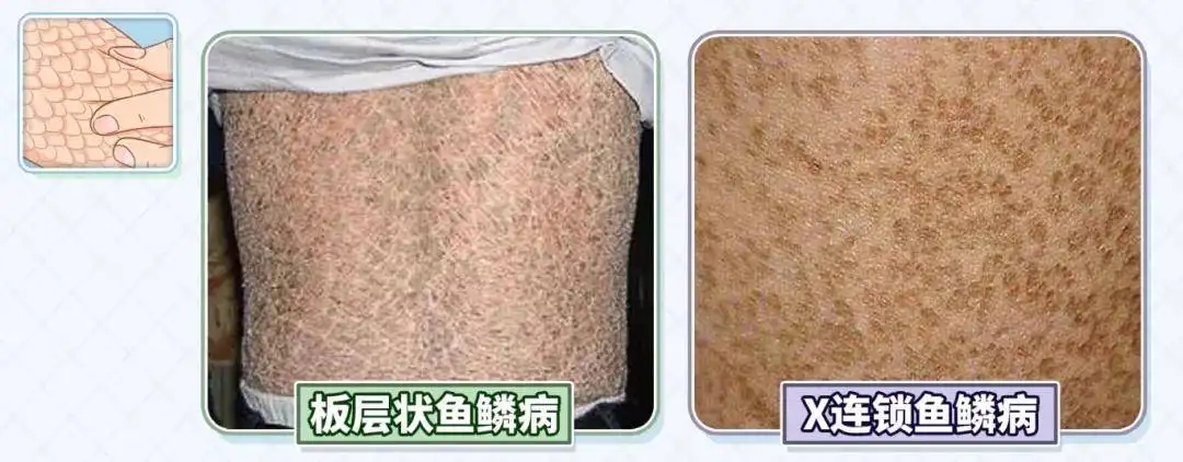 得了鱼鳞病怎么办